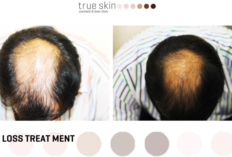 Hair Treatments