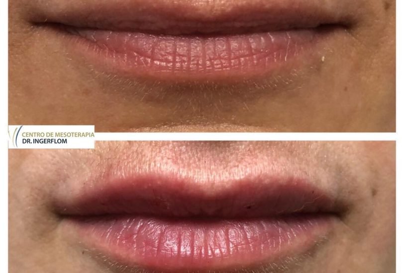 Lips Treatments