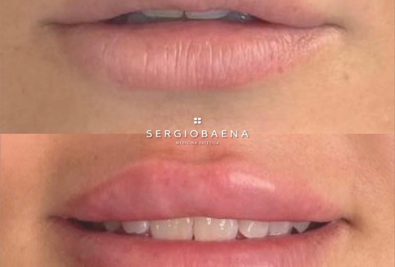 Lips Treatments