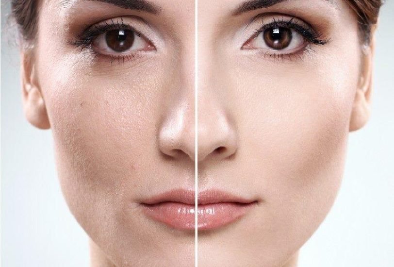 Facial Contouring & Lifting
