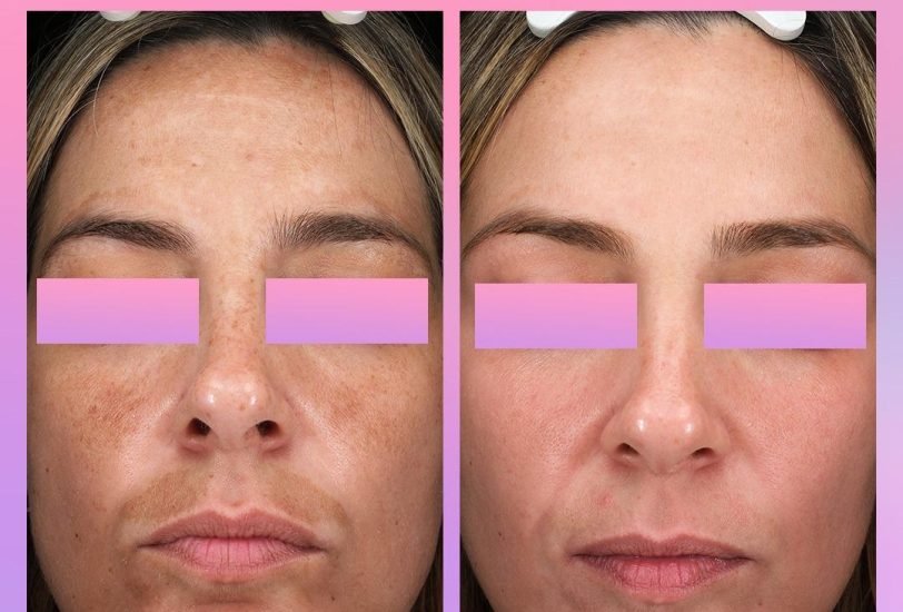 Scar Revision Treatments