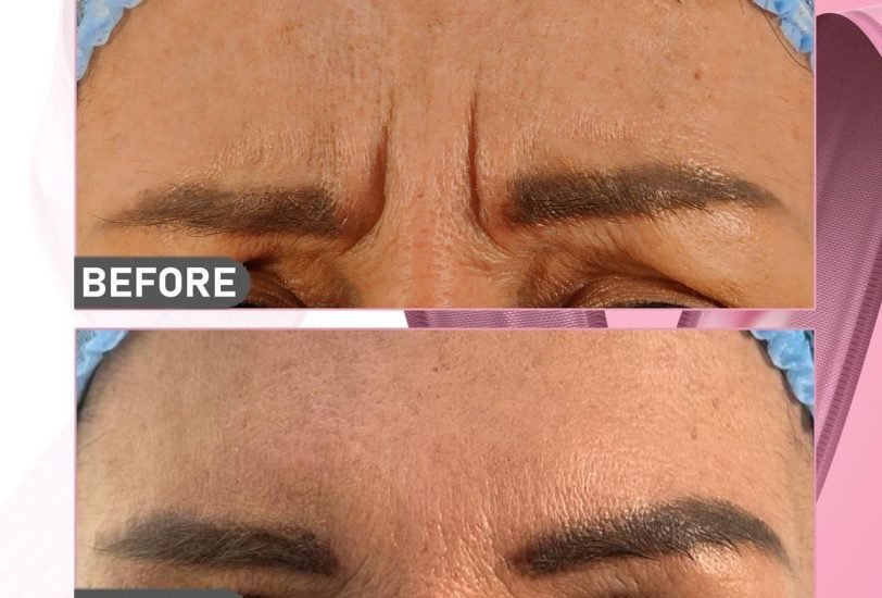 Injectable Treatments
