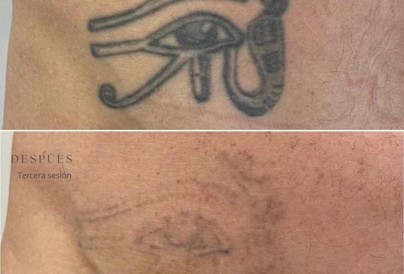 Scar Revision Treatments