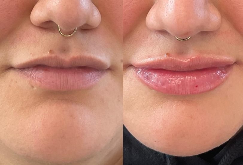 Injectable Treatments