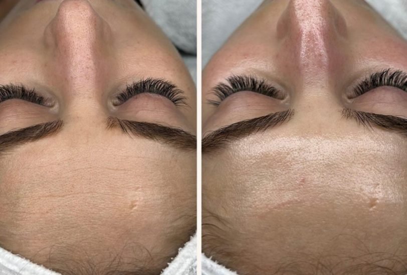 Acne & Scar Treatments