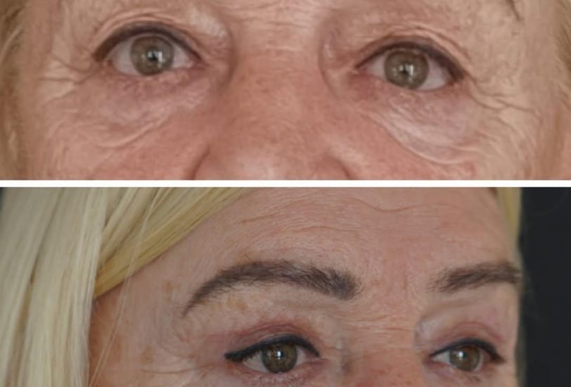 Eye Rejuvenation