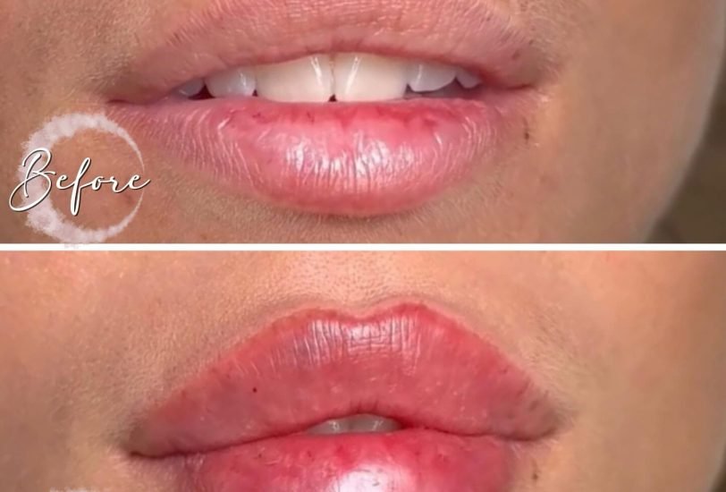 Lips Treatments