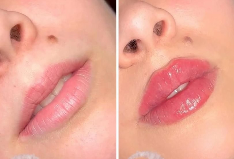 Injectable Treatments
