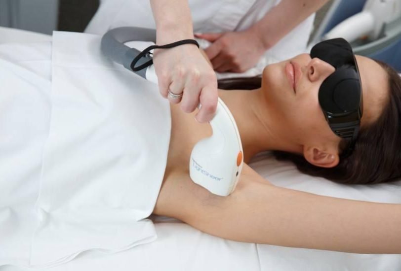 Laser Hair Removal