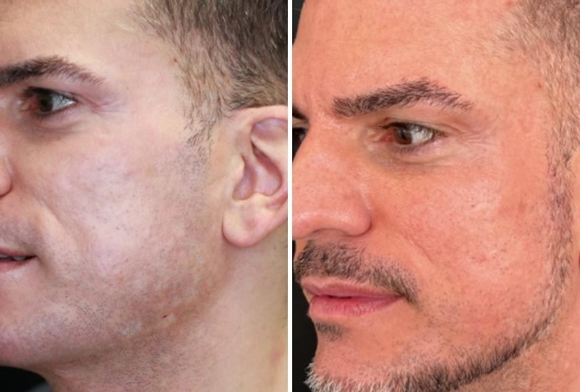 Facial Contouring & Lifting