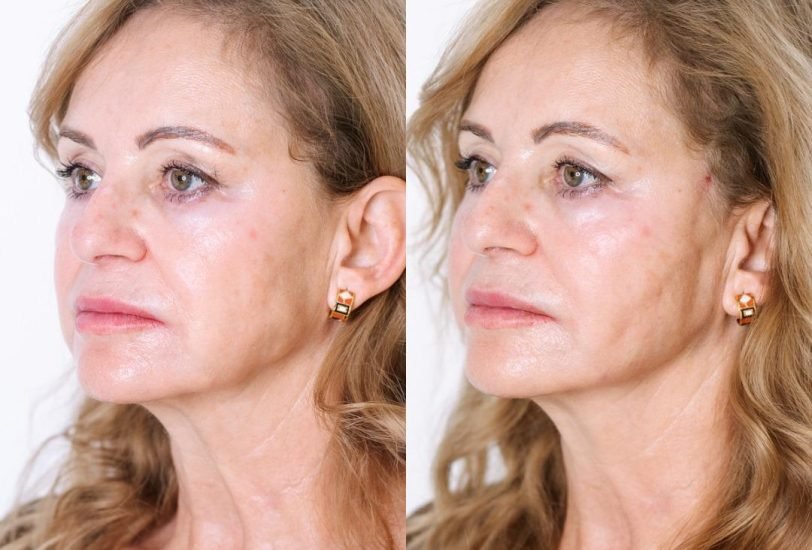 Facial Contouring & Lifting