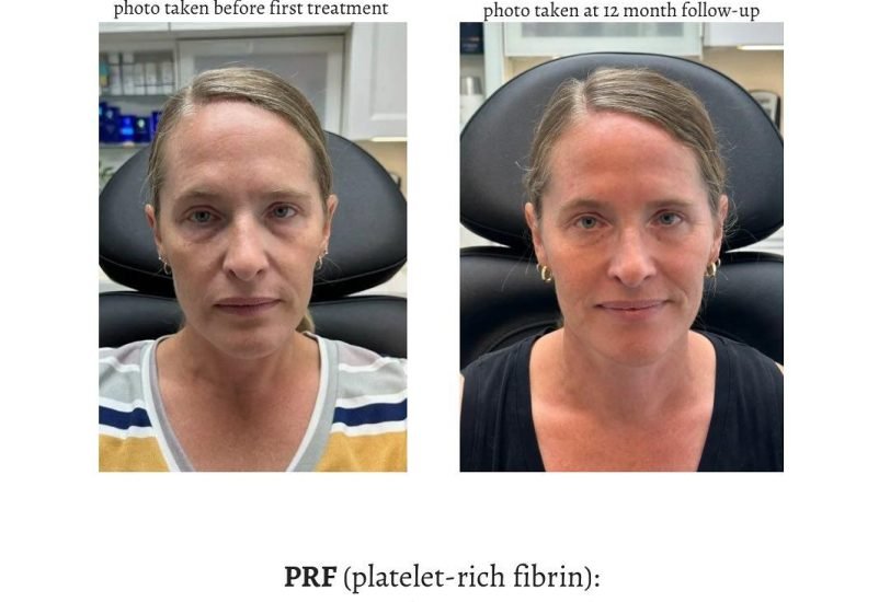 Skin Rejuvenation