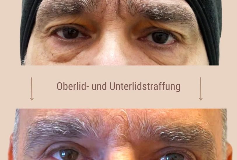 Eye Rejuvenation