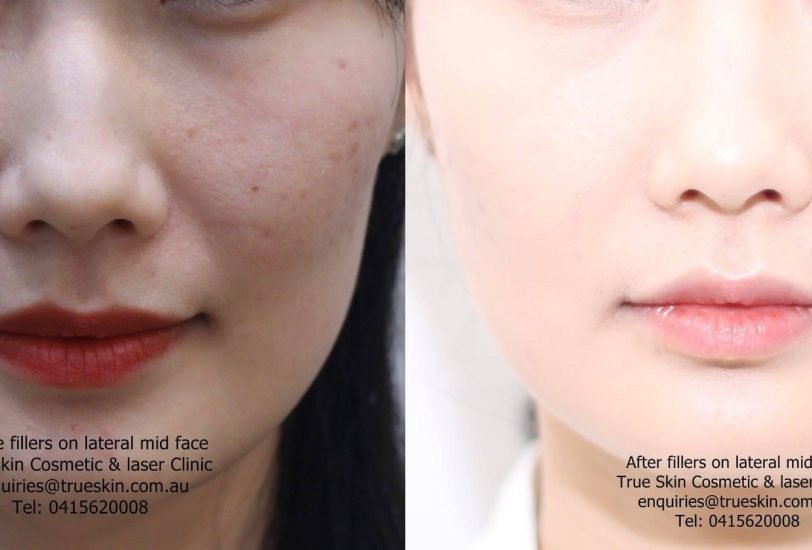 Acne & Scar Treatments