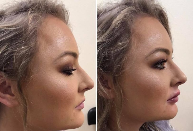 Double Chin & Jawline Contouring
