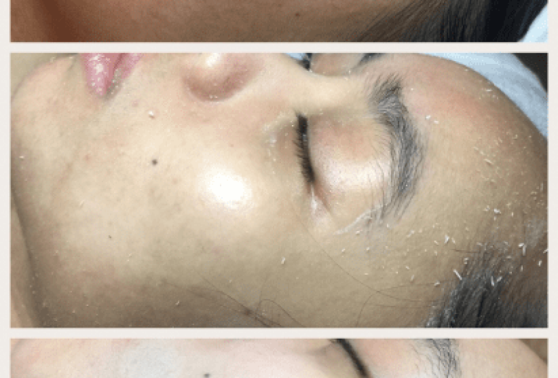 Acne & Scar Treatments
