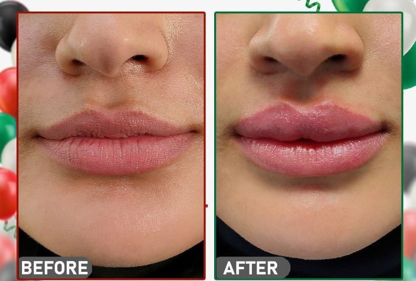 Lips Treatments