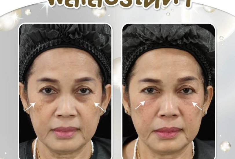 Facial Contouring & Lifting