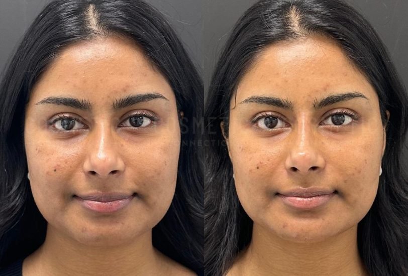 Acne & Scar Treatments
