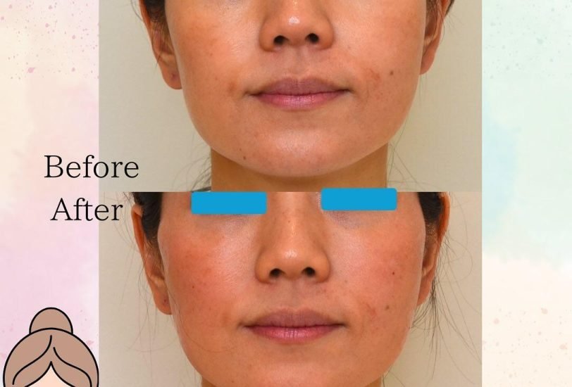 Acne & Scar Treatments