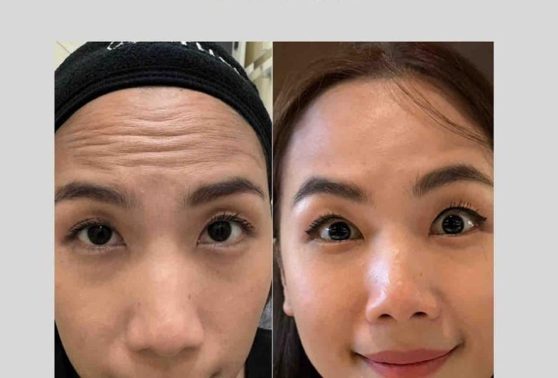 Anti-Aging Treatments