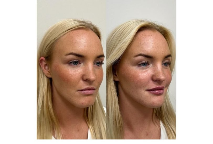 Double Chin & Jawline Contouring