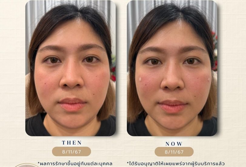 Facial Contouring & Lifting