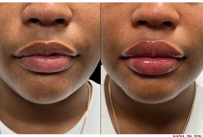Skin MD Boston 3 – VerifiedCare Lips Treatments