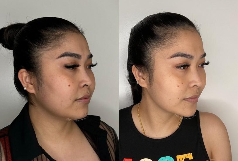 Facial Contouring & Lifting