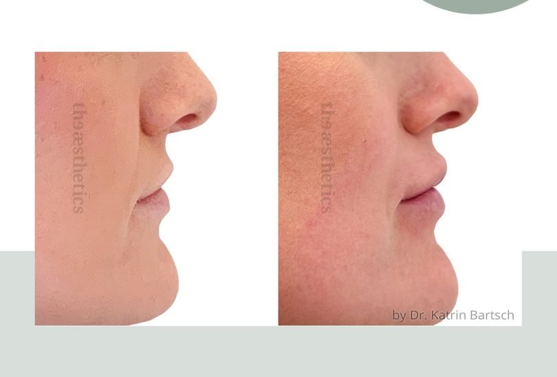 Scar Revision Treatments