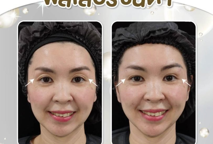 Anti-Aging Treatments