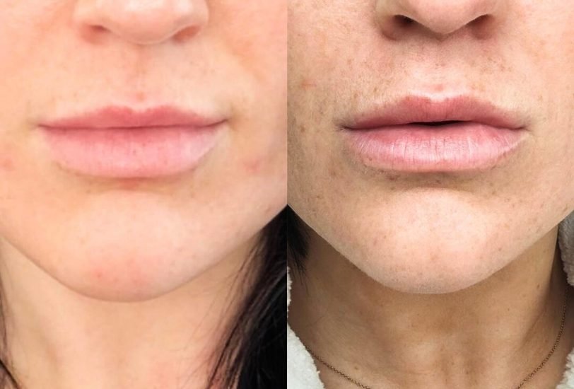 Lips Treatments
