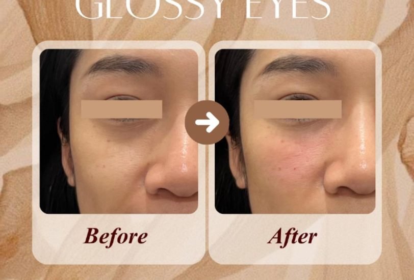 Facial Contouring & Lifting