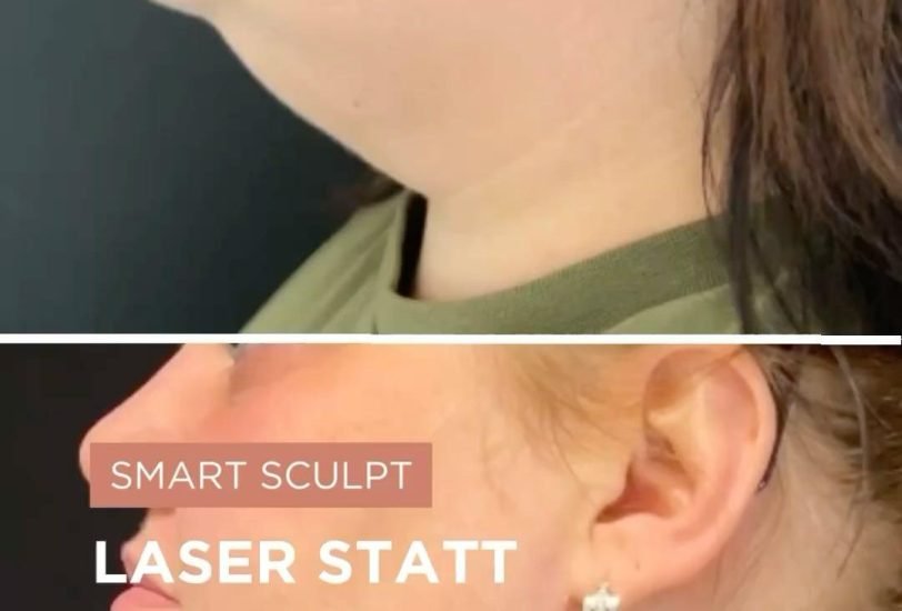 Fat Transfer