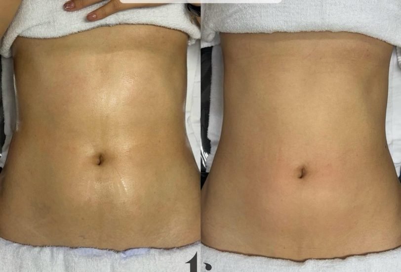 Body Contouring