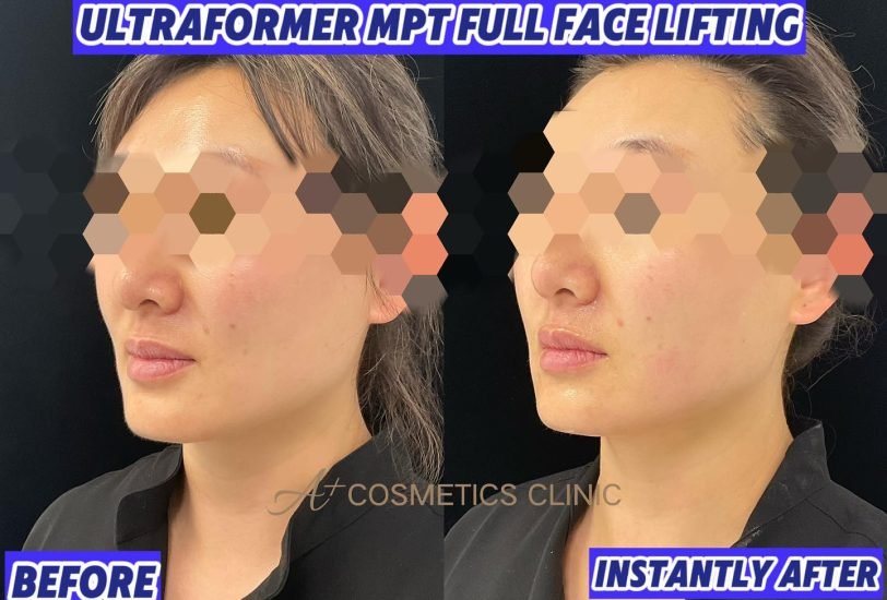 Laser & Light Therapies