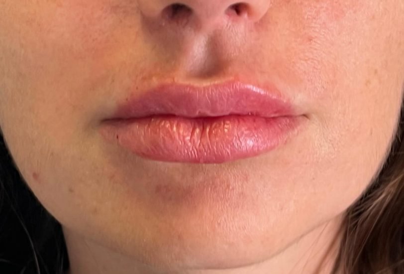 Lips Treatments