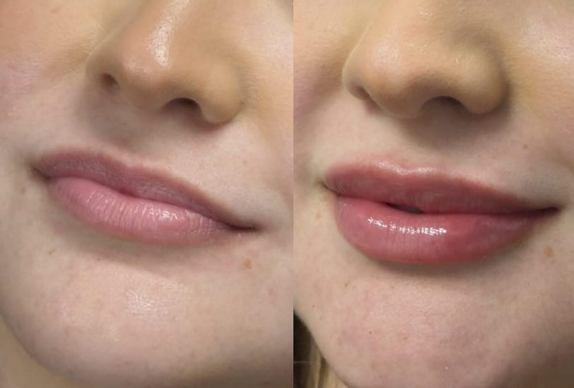 Lips Treatments