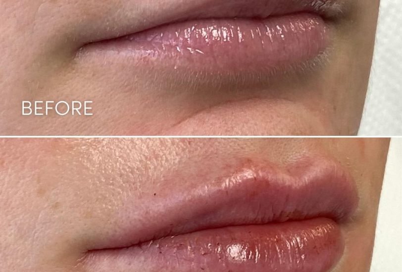 Lips Treatments