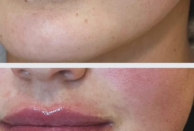 Lips Treatments