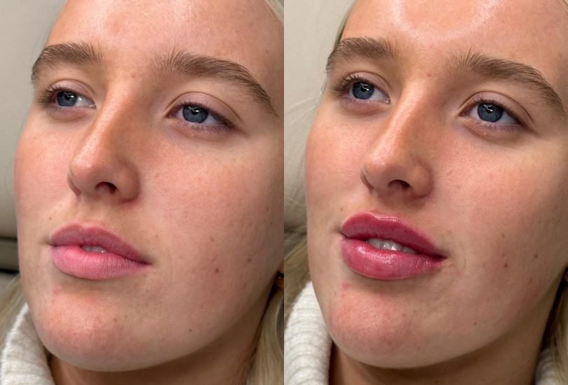 Injectable Treatments