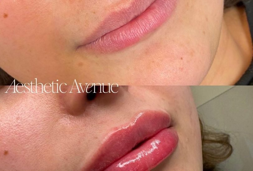 Lips Treatments