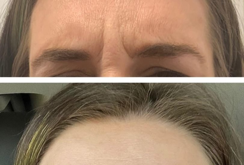 Injectable Treatments