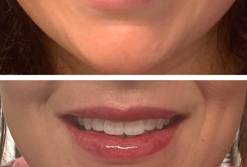 Lips Treatments