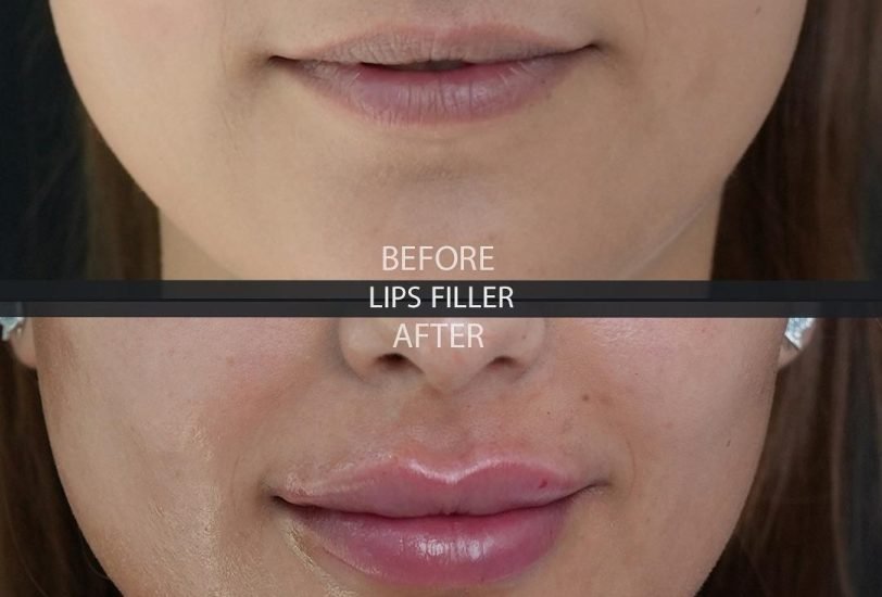 Lips Treatments