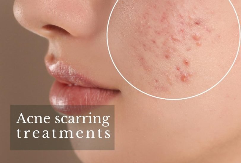 Acne & Scar Treatments