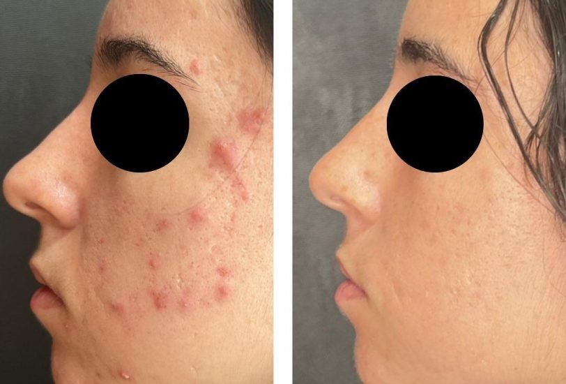 Acne & Scar Treatments