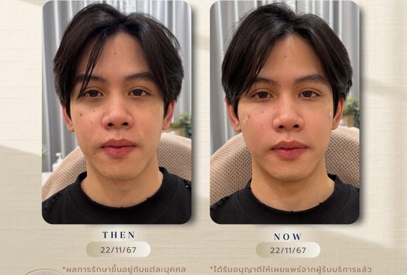 Double Chin & Jawline Contouring