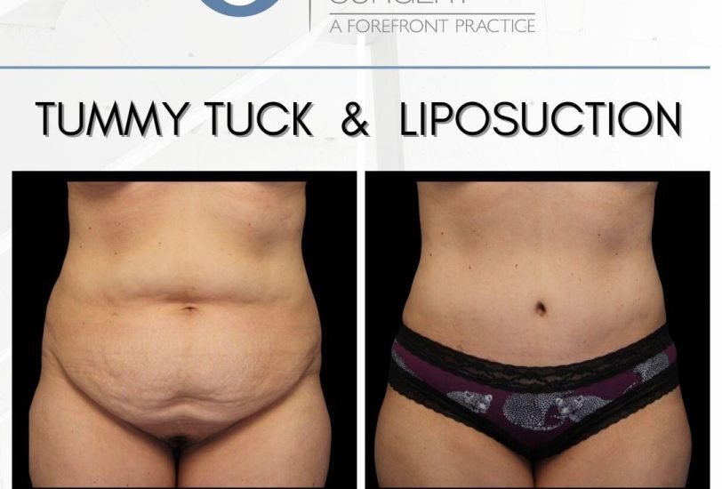 Tummy Tuck (Abdominoplasty)