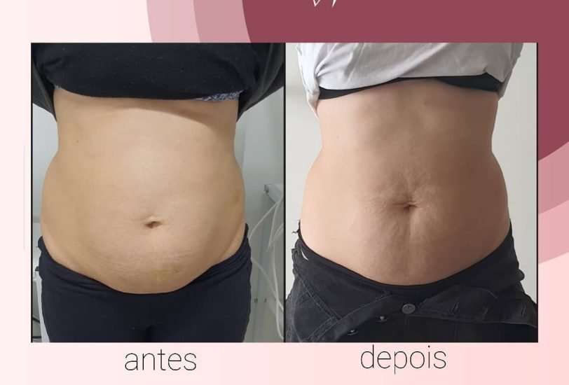 Body Contouring